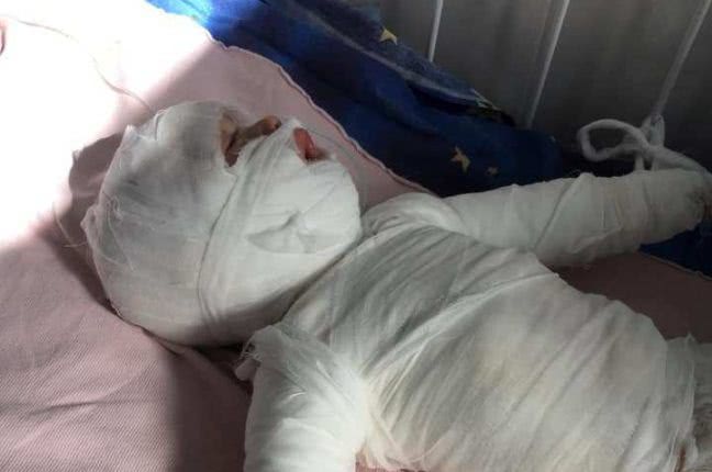 В Одесской области малыш получил 80% ожогов тела – нужна помощь