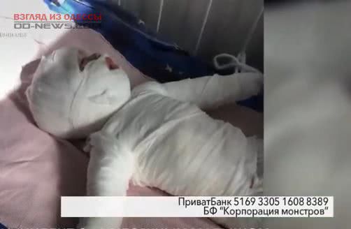 Волонтеры собрали рекордную сумму на лечение обварившегося маленького одессита