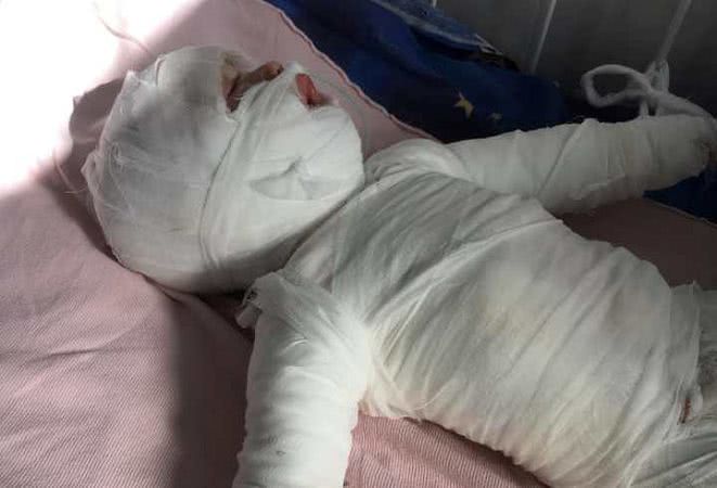 В Белгород-Днестровском районе 11-летнего малыша искупали в кипятке, ребенок в тяжелом состоянии