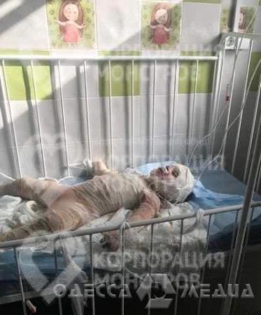 3-летний ребенок, который пострадал при пожаре в Одесской области, подключен к аппарату ИВЛ