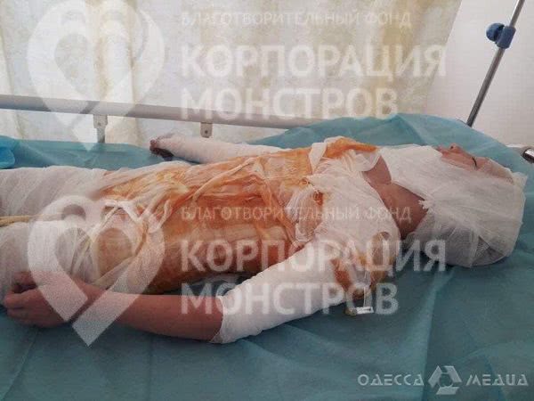 11-летний ребенок в Одесской области получил 50% ожогов паром