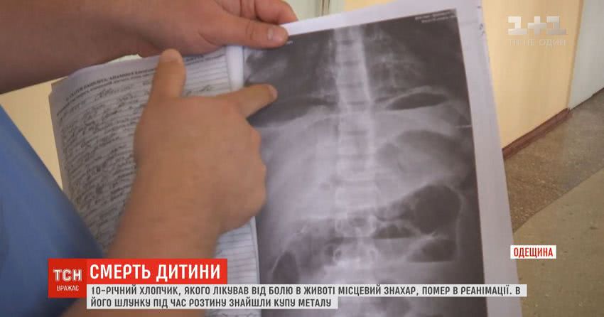 В Одеській області помер 10-річний хлопчик: у його шлунку знайшли купу металу