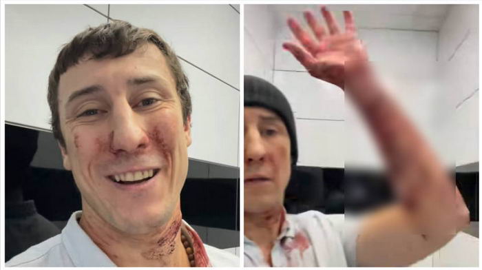 Одесский уклонист порезал себе руки в ТЦК, только чтобы не защищать страну