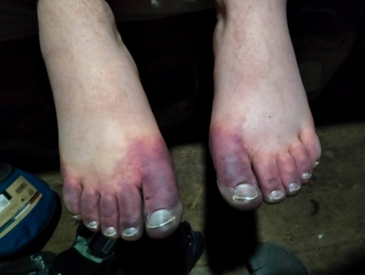 Одессит решил сам забраться на Говерлу, но заблудился и получил обморожение ног